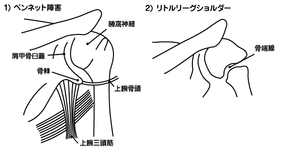 1)�x���l�b�g��Q 2)���g�����[�O�V�����_�[