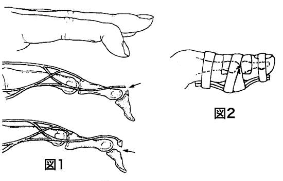 �}���b�g�t�B���K�[